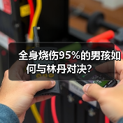 全身烧伤95%的男孩如何与林丹对决？