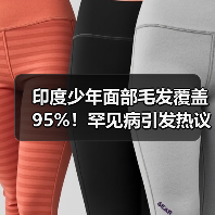 印度少年面部毛发覆盖95%！罕见病引发热议（图1）