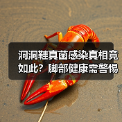 洞洞鞋真菌感染真相竟如此?脚部健康需警惕(图2) 洞洞鞋真菌感染真相竟如此?脚部健康需警惕(图2)
